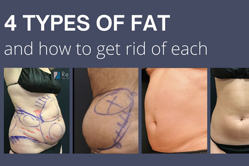 The 4 Types of Fat and The Most Effective Way to Lose Each