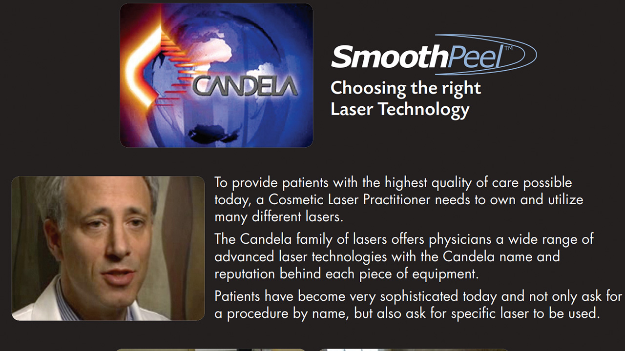 Candela SmoothPeel laser feature in Wavelengths, alternative to a chemical peel
