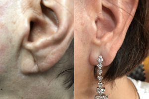 Keep Your Earlobes Free Of Unwanted Holes .