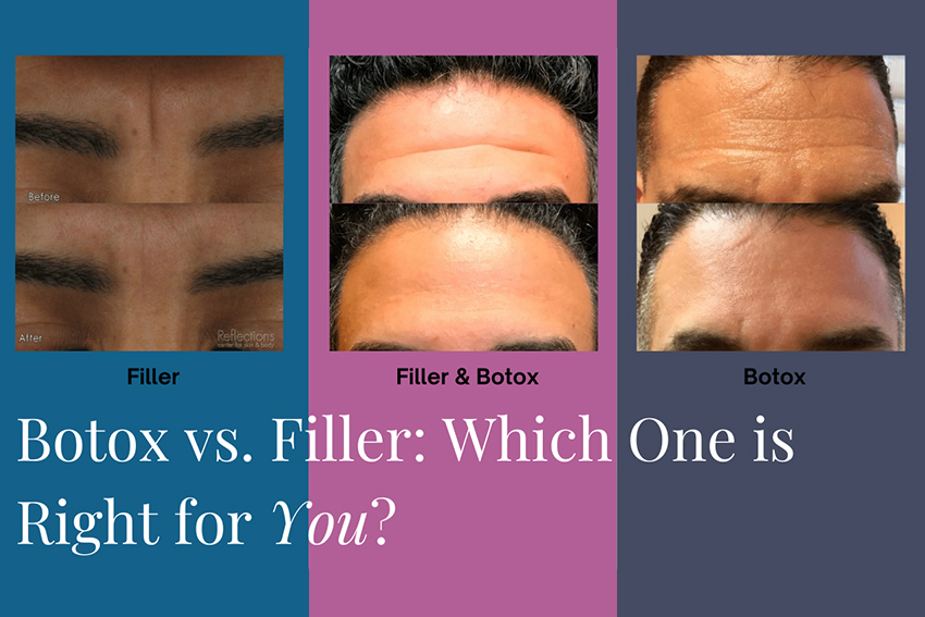 Best on sale wrinkle filler