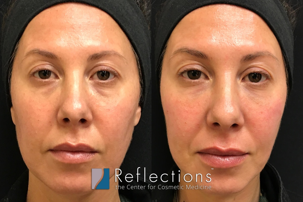 best-restylane-specials-near-me-nj-under-eye-fillers-price-cost