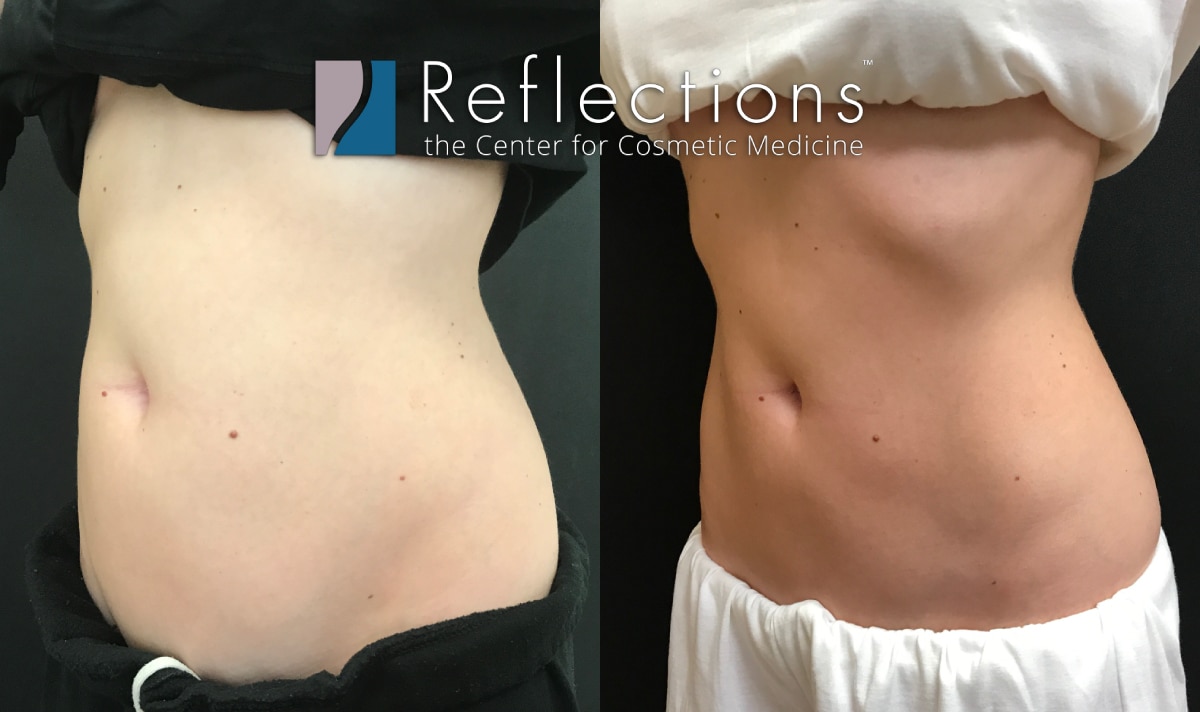 CoolSculpting for A Toned Tummy Before & After Photos New Jersey -  Reflections Center