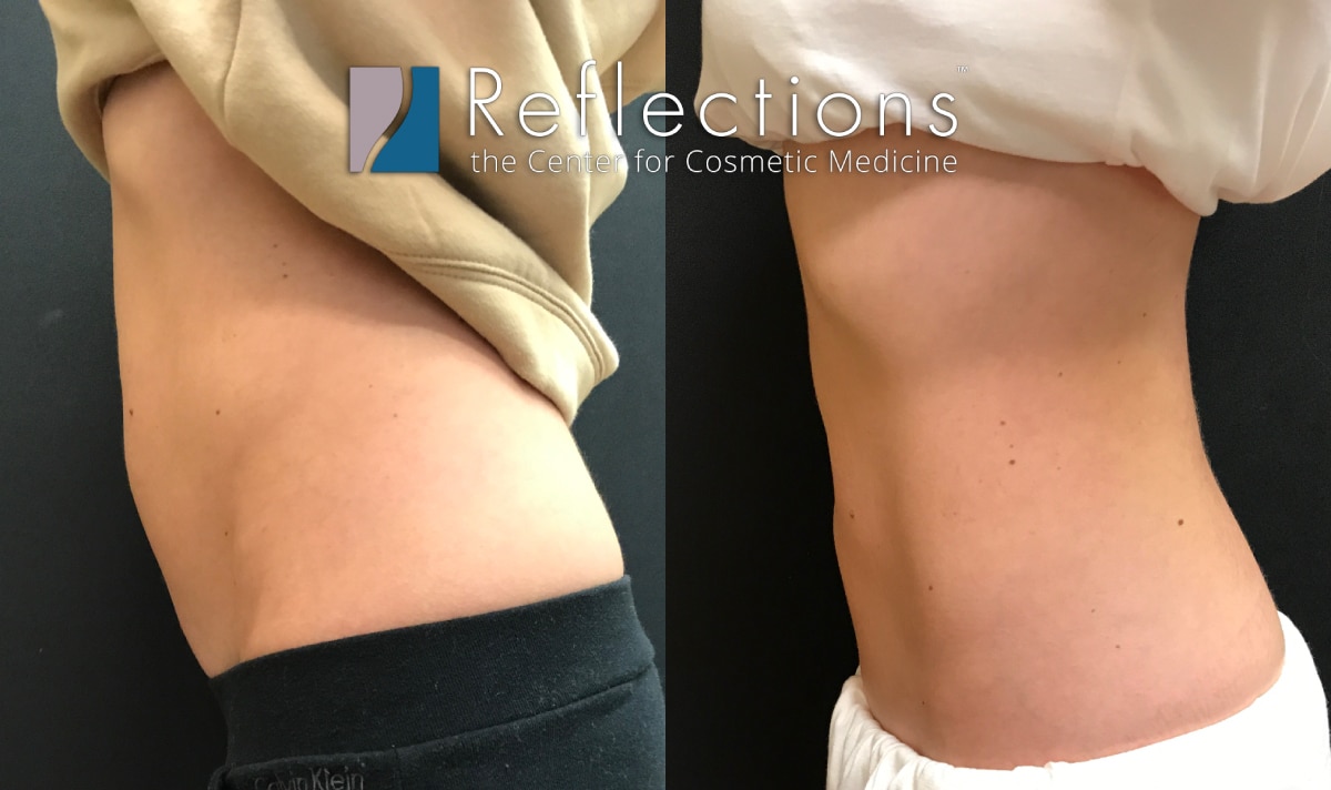 CoolSculpting for A Toned Tummy Before & After Photos New Jersey
