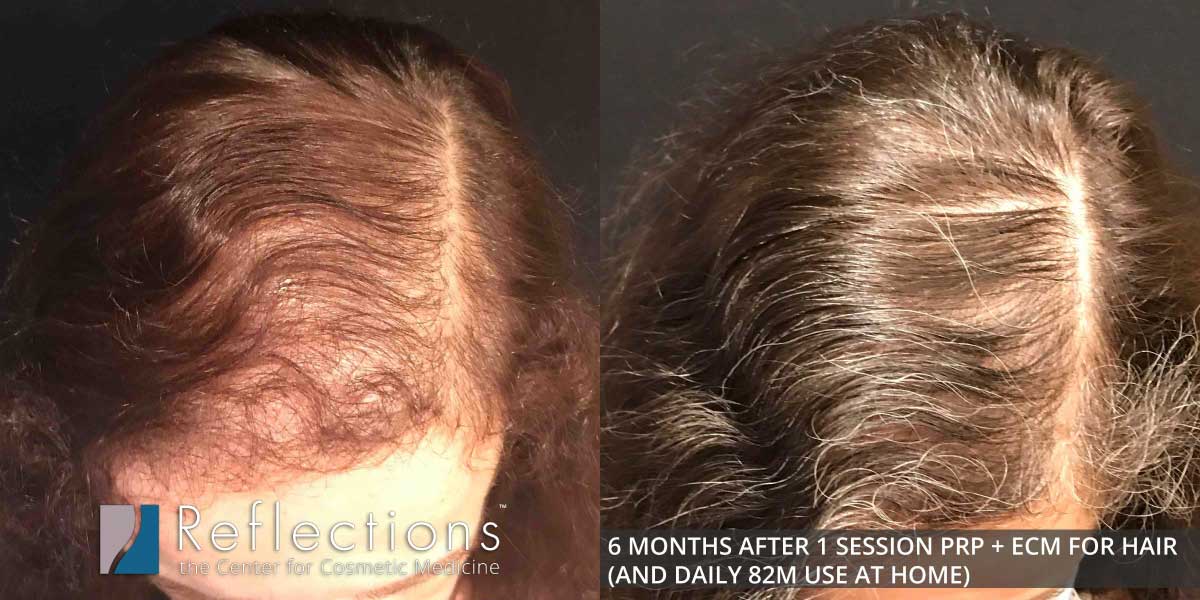 Injections for Hair Restoration Before & After Photos New Jersey -  Reflections Center
