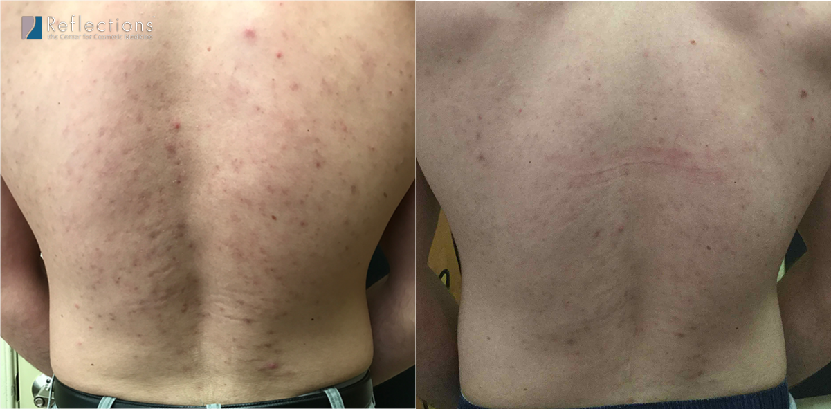 Bacne [Back Acne & Acne Scars] Treated with Lasers Before & After Photos  New Jersey - Reflections Center