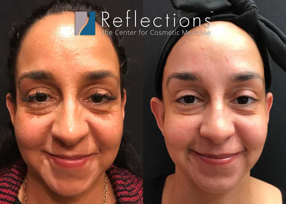 Jawline Filler for Definition & Contour (Updated 2023) – Mabrie Facial  Institute