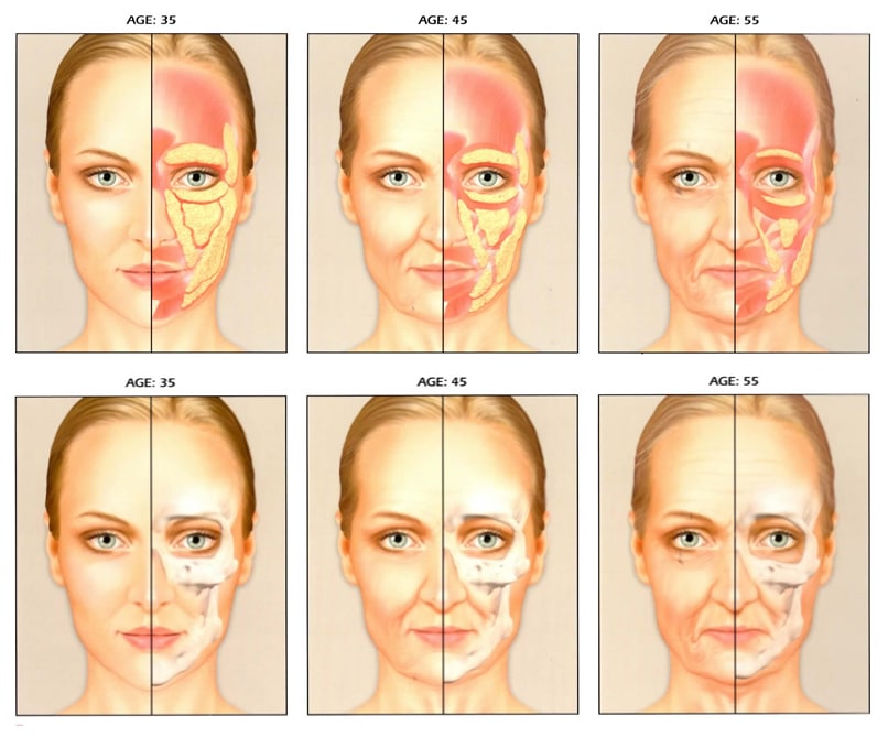 Facial Aging is not just loose skin - there are bone, muscle, and fat changes at play, too!