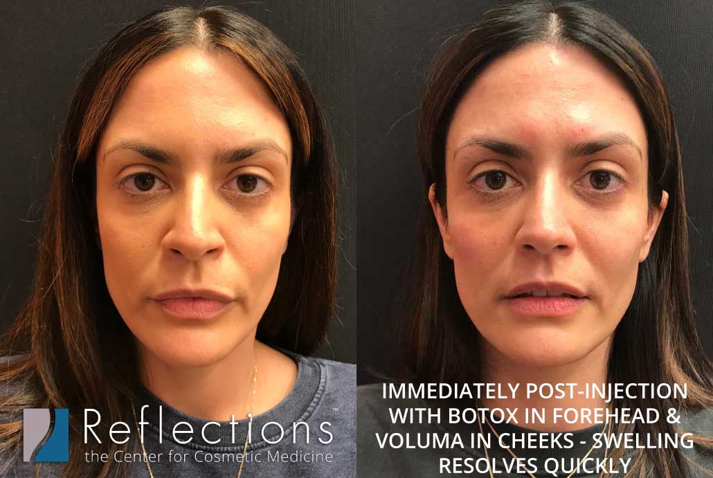 Post-Quarantine Glow-Up: Botox, Filler, & Laser Treatments Before & After  Photos New Jersey - Reflections Center