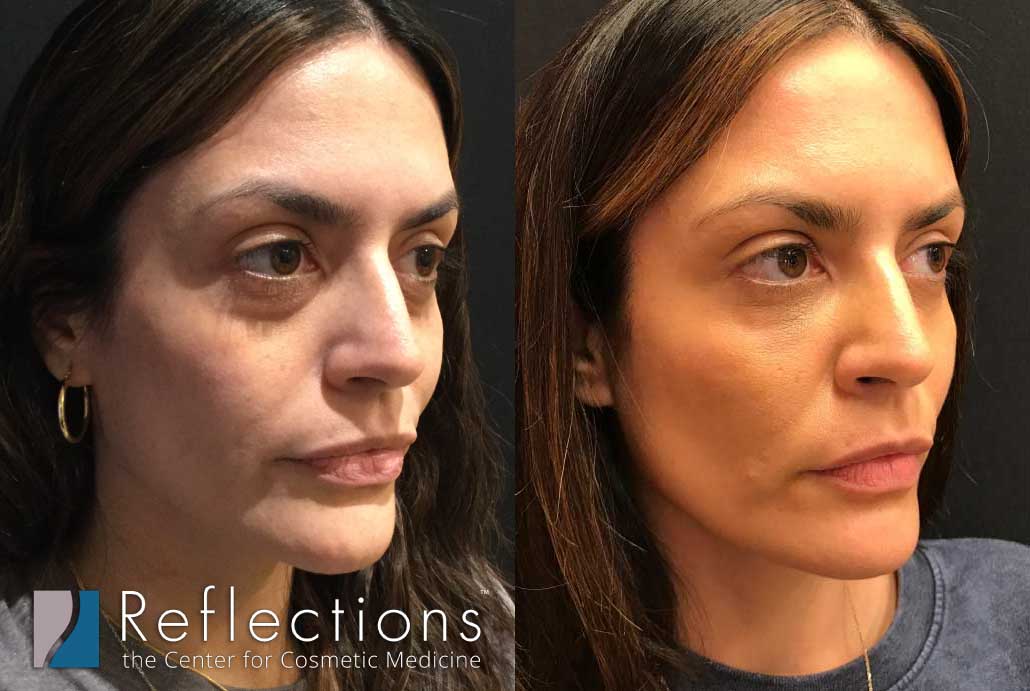 Post-Quarantine Glow-Up: Botox, Filler, & Laser Treatments Before & After  Photos New Jersey - Reflections Center