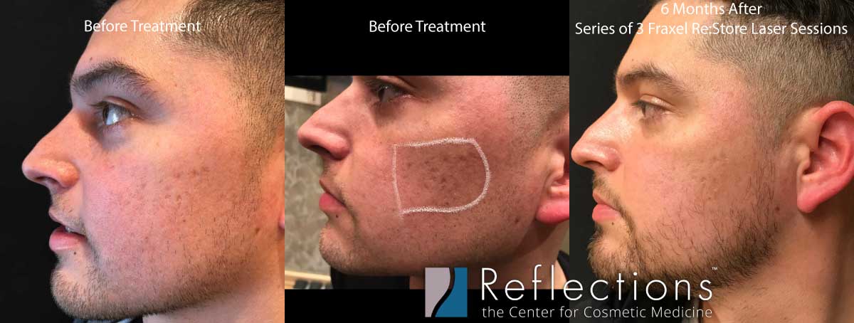 Fraxel Laser Results For Acne Scars On Hispanic Skin Before And After