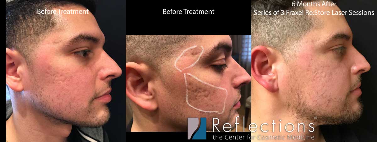 Cirkel mærkning Literacy Acne Scars Before & After Photos New Jersey | Reflections