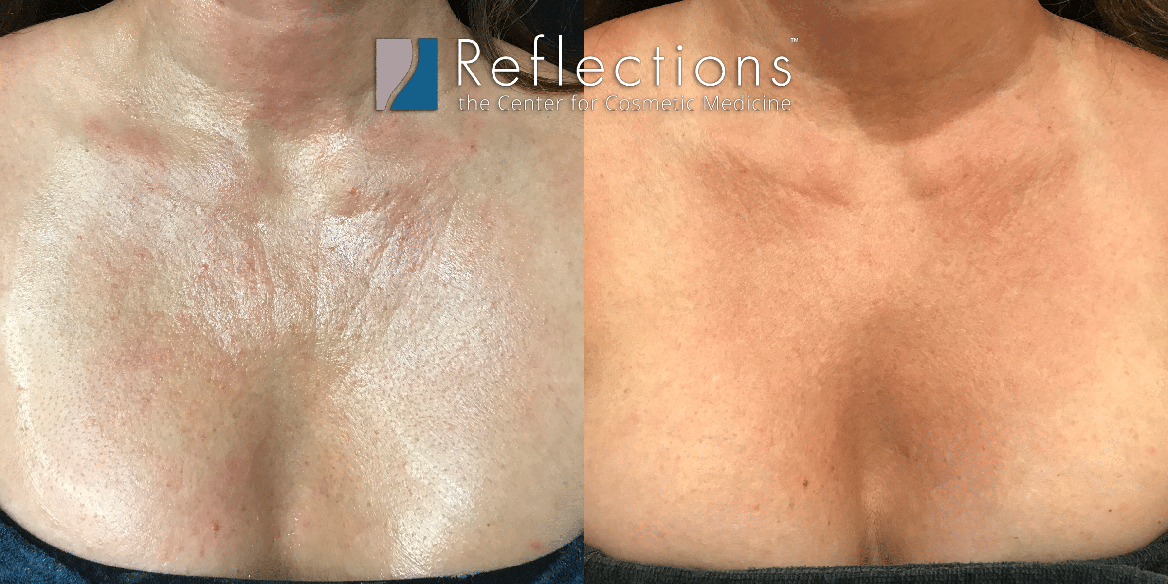 Chest Wrinkles from Sleeping and Sun Damage Removed with Fraxel