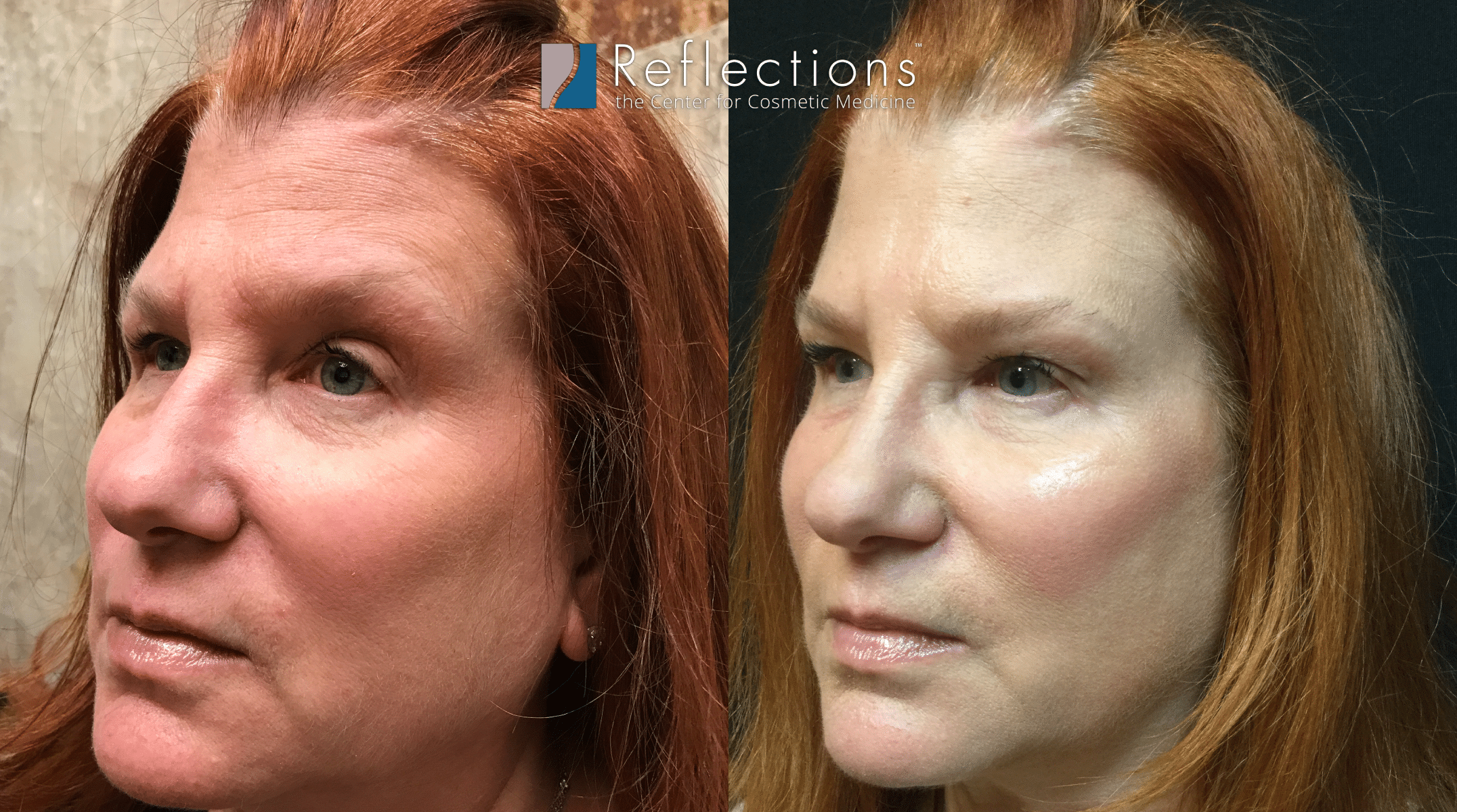 HA Rejuve™ Results with Glutathione & Hyaluronic Acid Microneedling Before  & After Photos New Jersey - Reflections Center