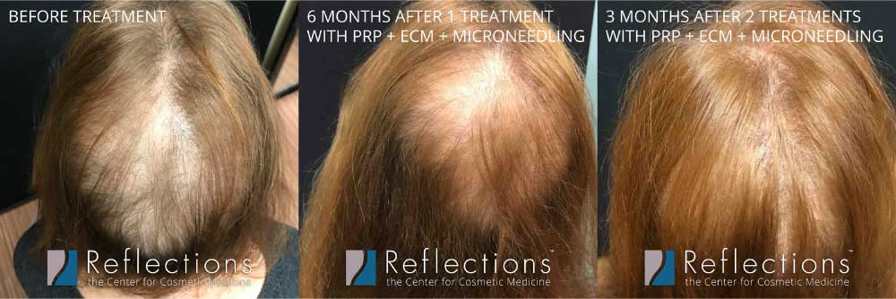 Hair Injections Results for Woman with Balding on Back of Head Before &  After Photos New Jersey - Reflections Center