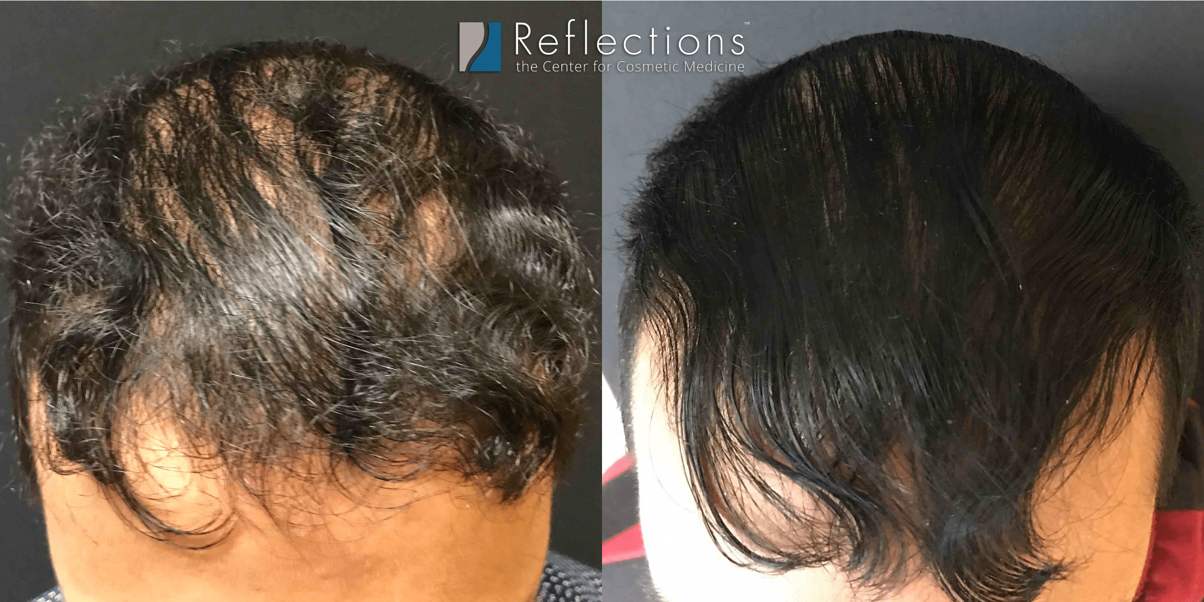 Results from 3 Sessions of Hair Regrowth Injections Before & After Photos  New Jersey - Reflections Center
