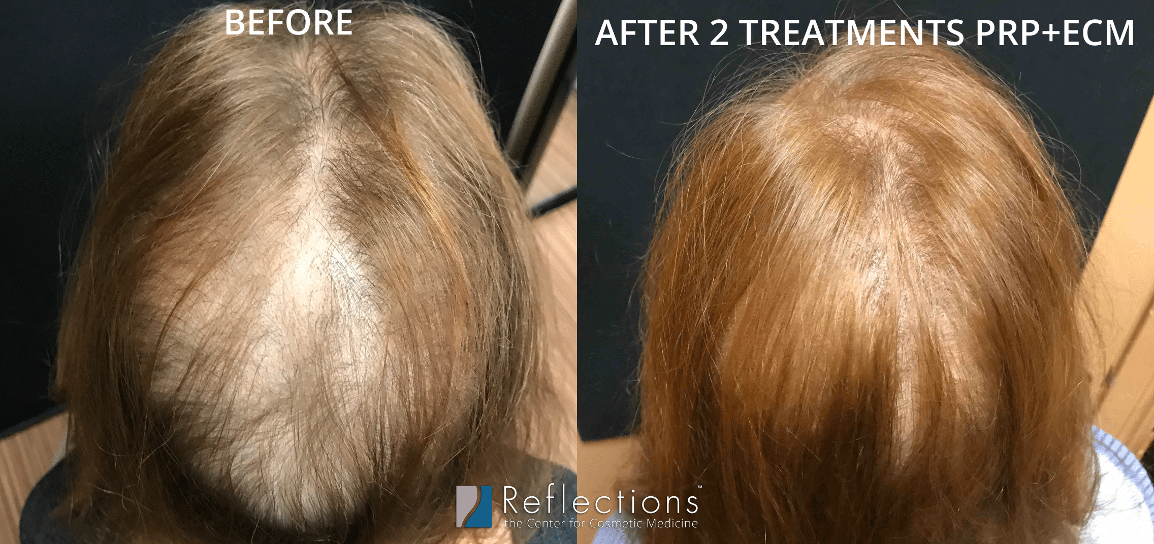 Hair Restoration Injections + Shampoo Results for Woman Before & After  Photos New Jersey - Reflections Center