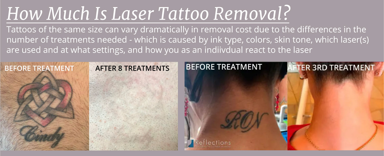 Reducing the Cost of Tattoo Removal: How to Maximize Your Laser Tattoo  Removal Treatments' Results - Reflections Center