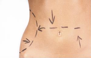 Reflections for laser liposuction. 
