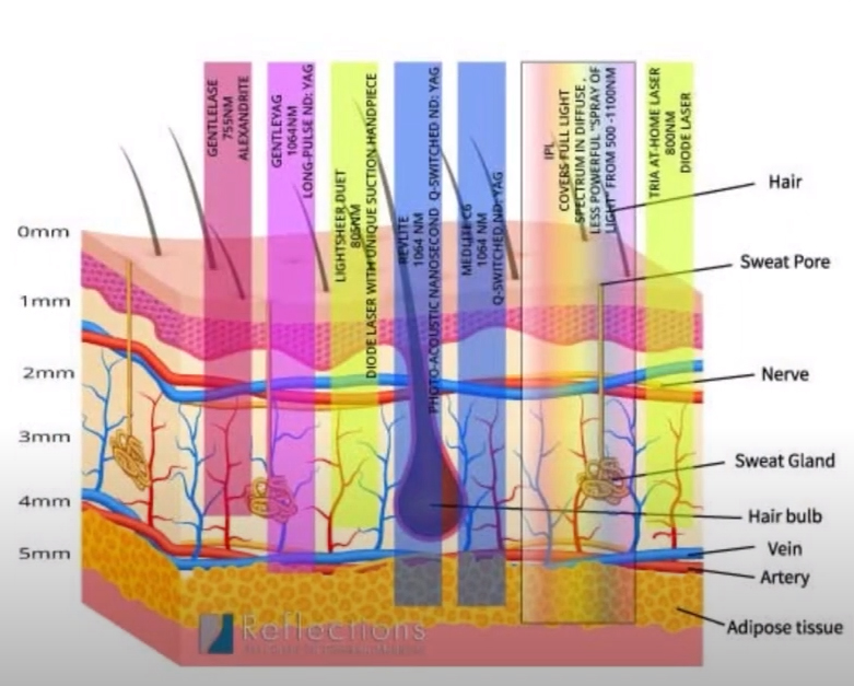 Laser Hair Removal Effectiveness Explained