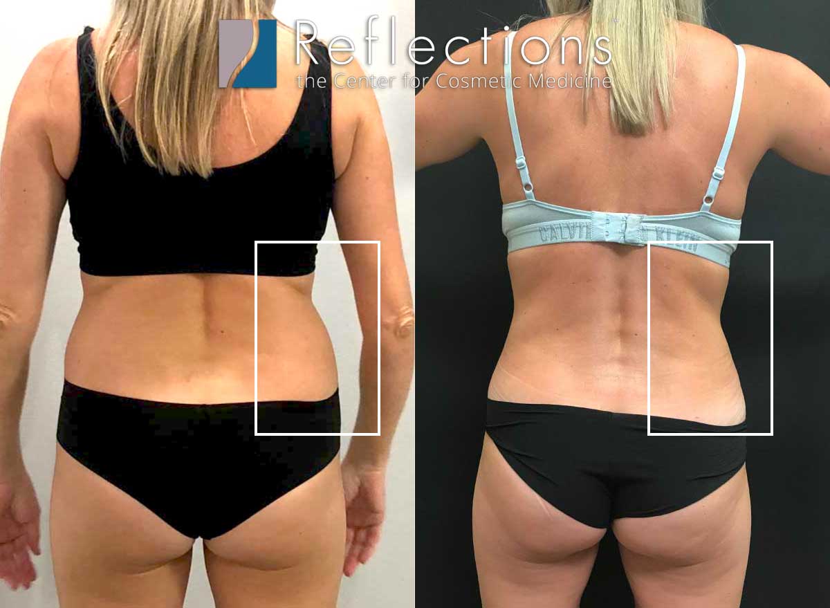 Liposuction of the 'love handles' or flanks