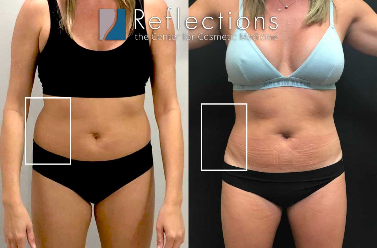 Laser Liposuction Before & After Photos New |