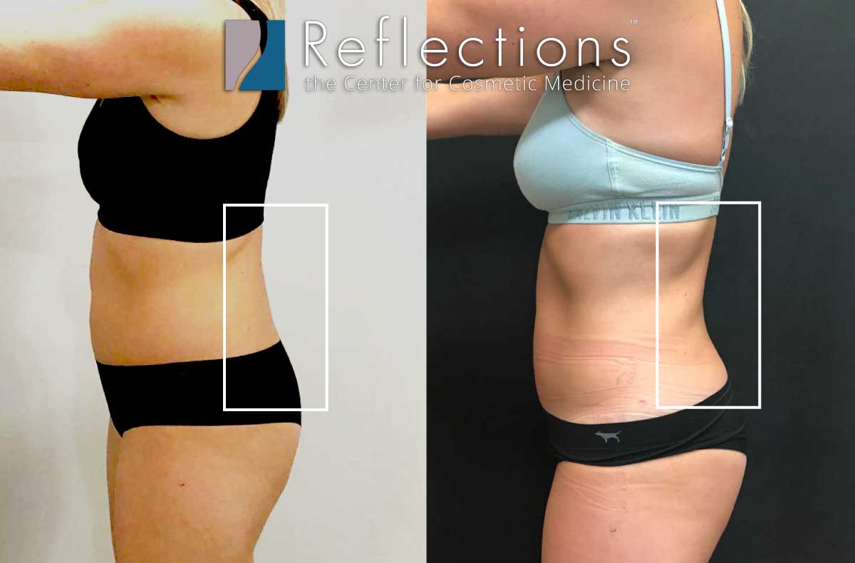 Eliminate Love Handles with Liposuction of the Flanks!