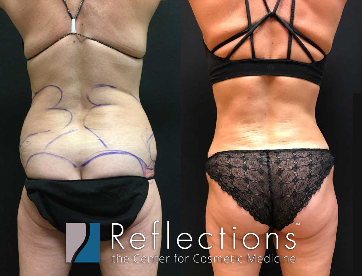 Eliminate Love Handles with Liposuction of the Flanks!