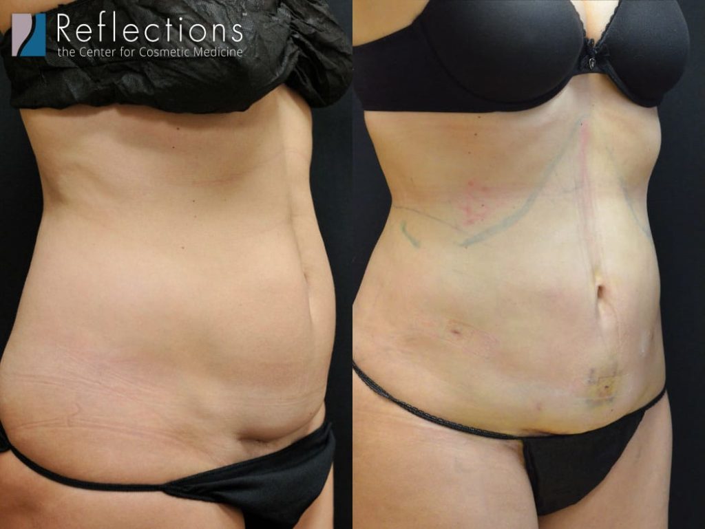 C-section scar revision with laser lipo