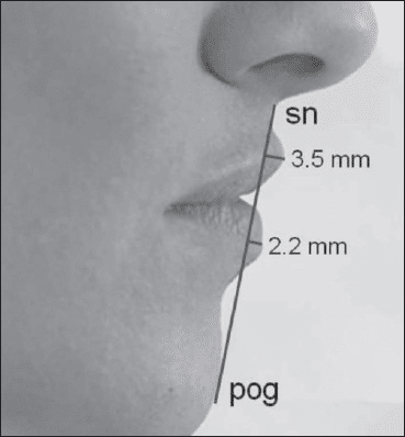 Lip Filler Proportions