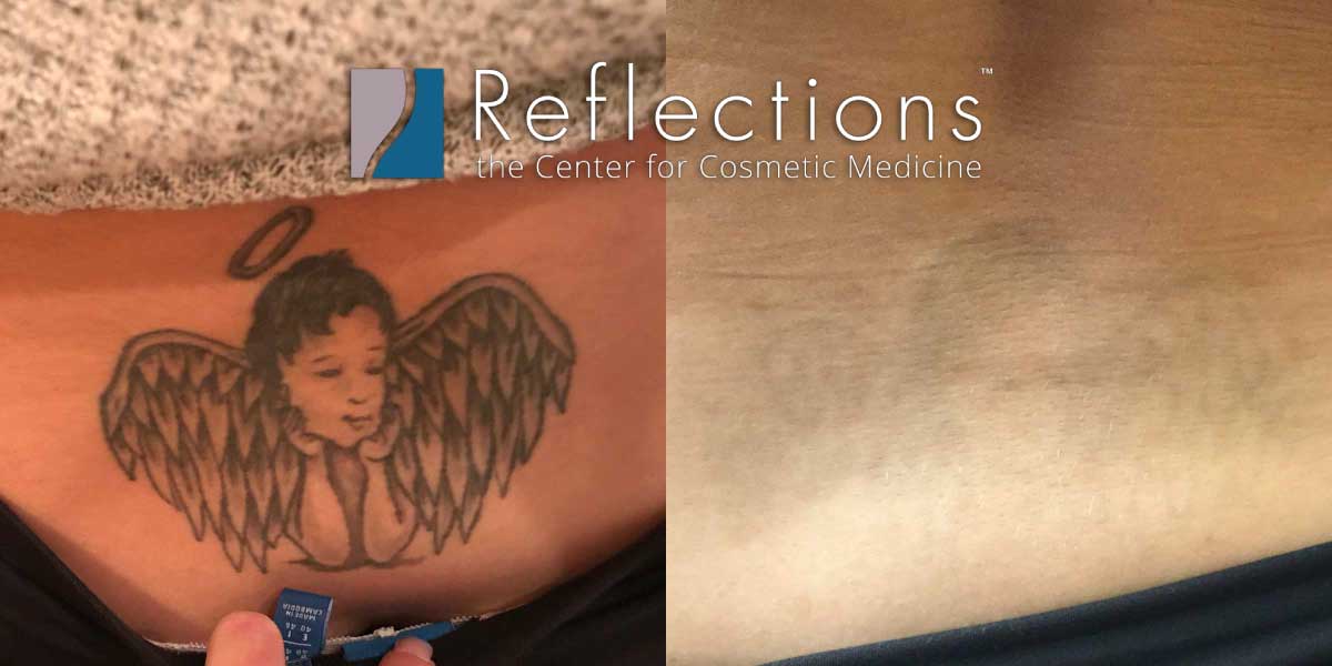 Lower Back Tattoo Removed with Laser Tattoo Removal Before & After Photos  New Jersey - Reflections Center