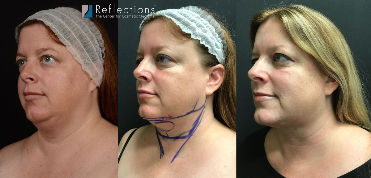 plantador Migración Paradoja Laser Lipo Results for Double Chin on New Jersey Woman Before & After  Photos New Jersey - Reflections Center