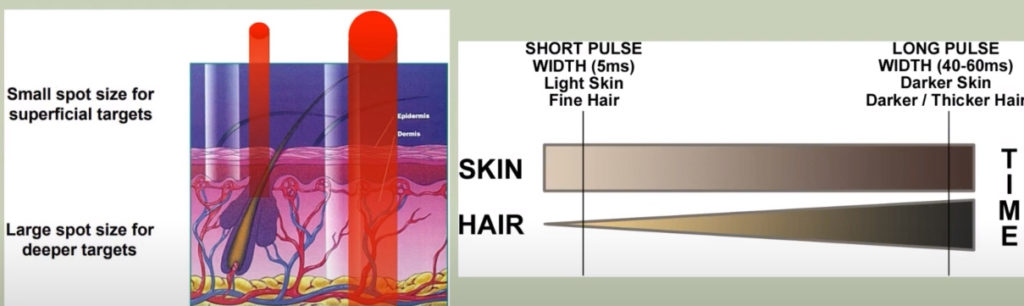 Pulse And Spot Size in Laser Hair Removal