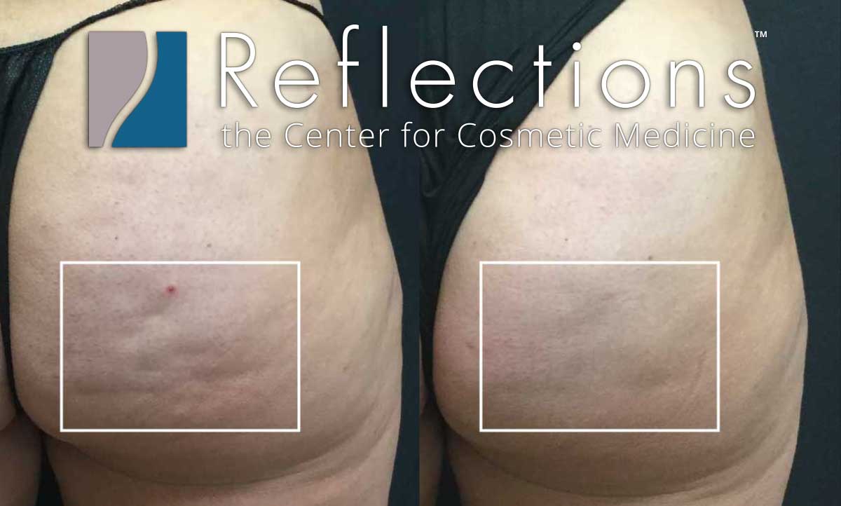 Qwo Cellulite Removal Injections Sale - $1900 Near Me in NJ