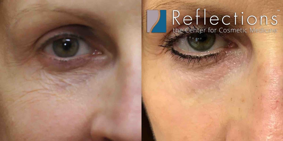 Rf Microneedling For Improvement Of Crepey Skin Under Eyes Before