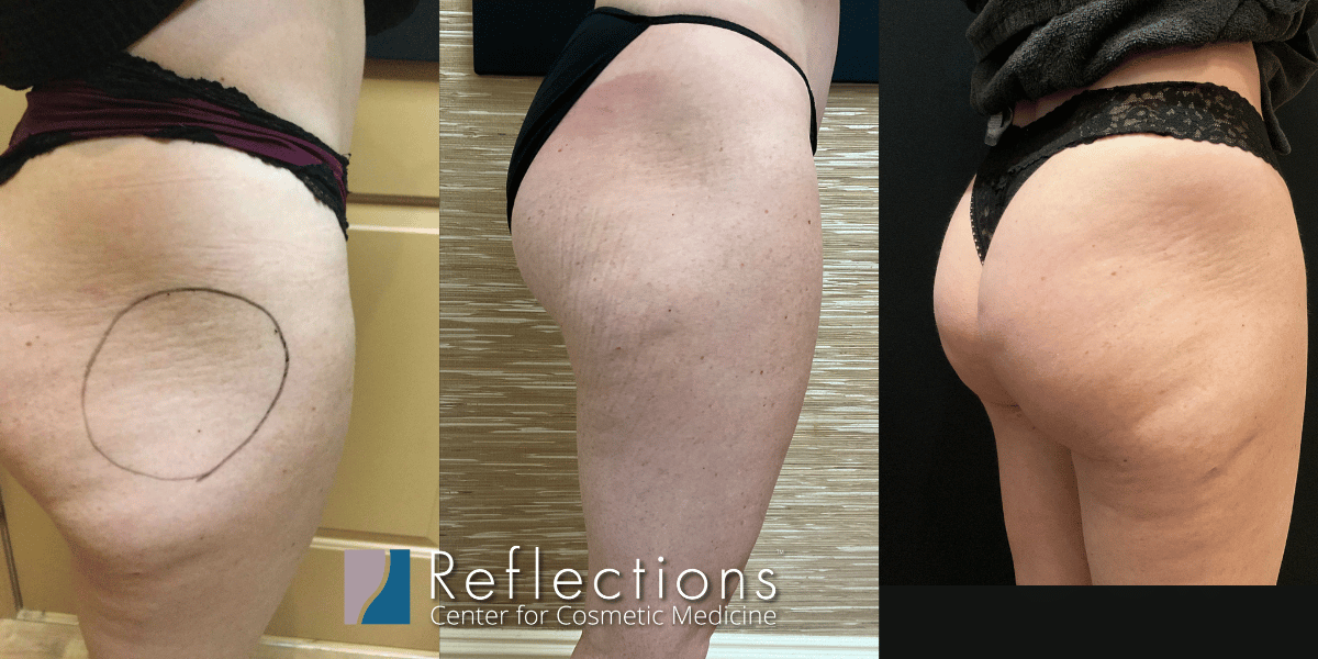 Sculptra Injections for Rounder Butt [Hip Dips] Before & After Photos New  Jersey - Reflections Center