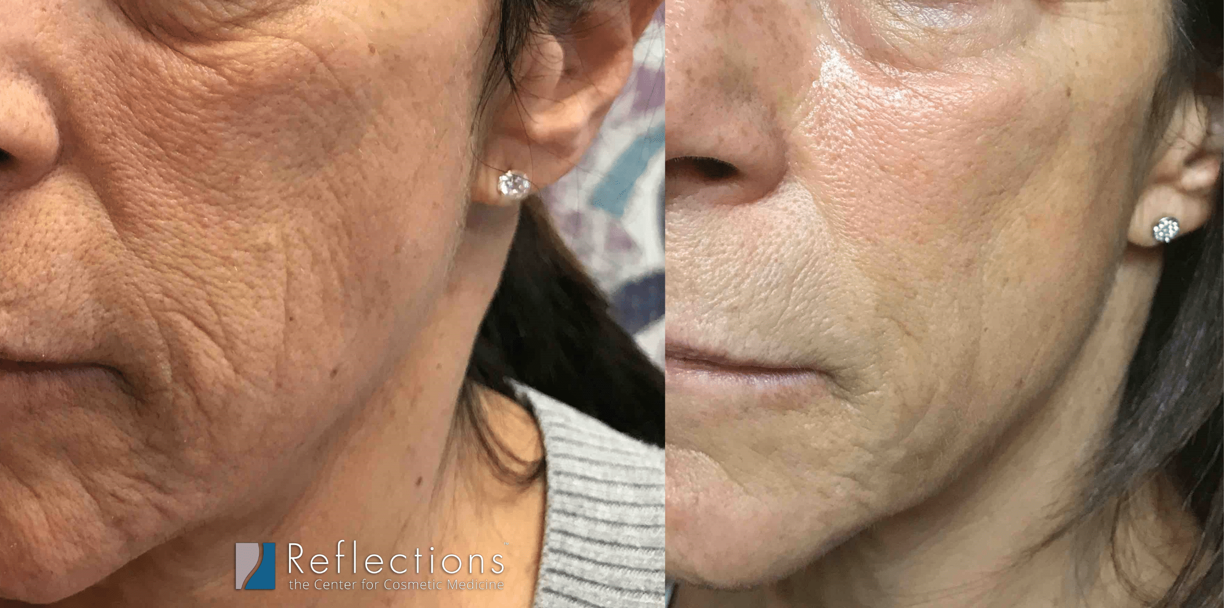 Fraxel Co2 Laser For Fine Lines And Wrinkles Before And After Photos New