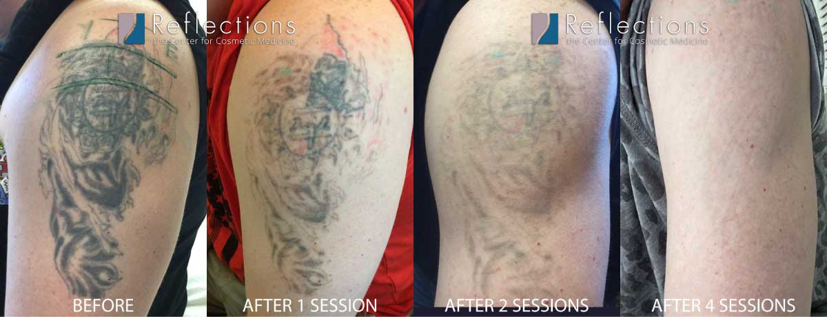 Sleeve Tattoo Gone in Just 4 Laser Sessions Before & After Photos New  Jersey - Reflections Center