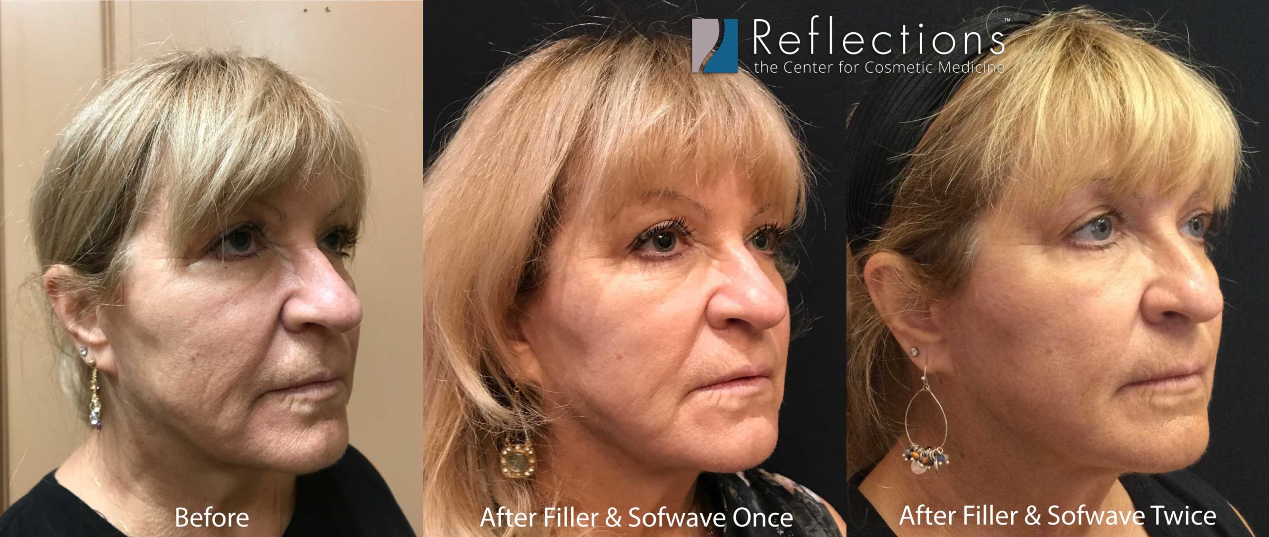 best-restylane-specials-near-me-nj-under-eye-fillers-price-cost
