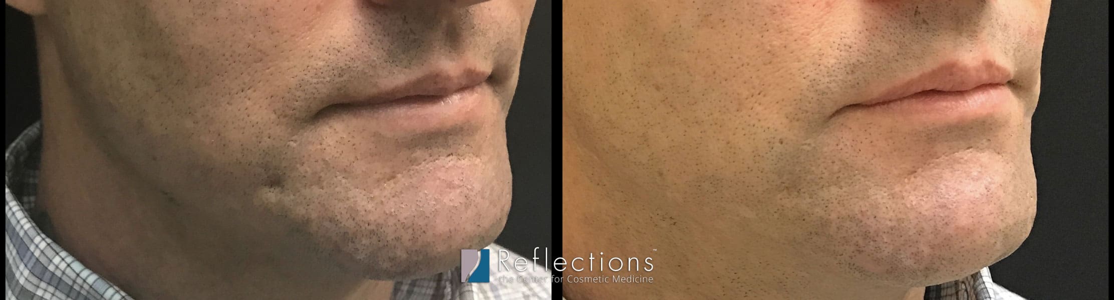 Filler For Deep Acne Scar