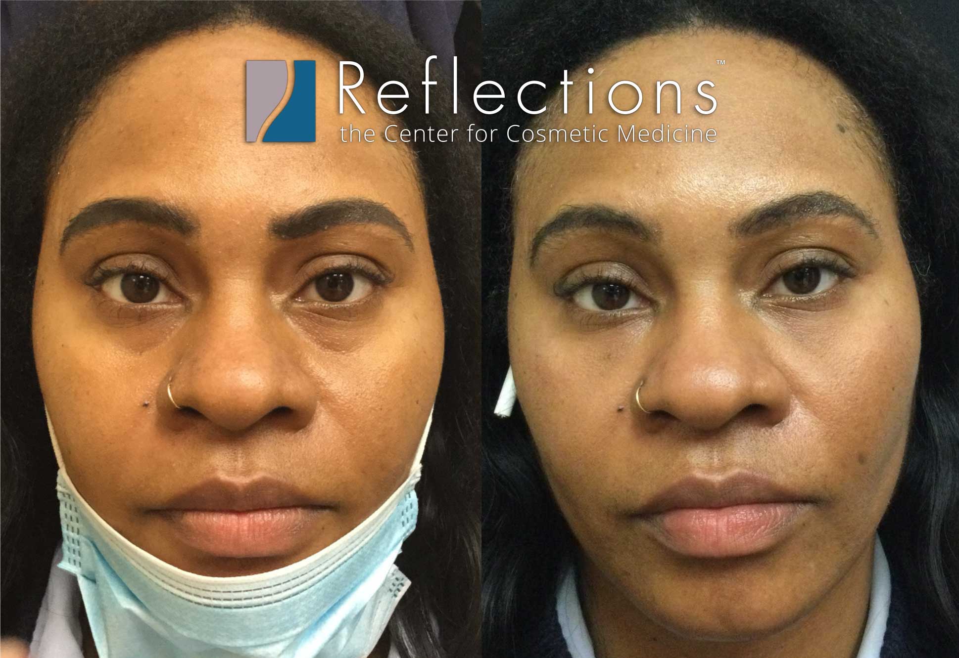 Under Eye Filler with Cheek Support Pre-Treatment with Filler Before &  After Photos New Jersey - Reflections Center