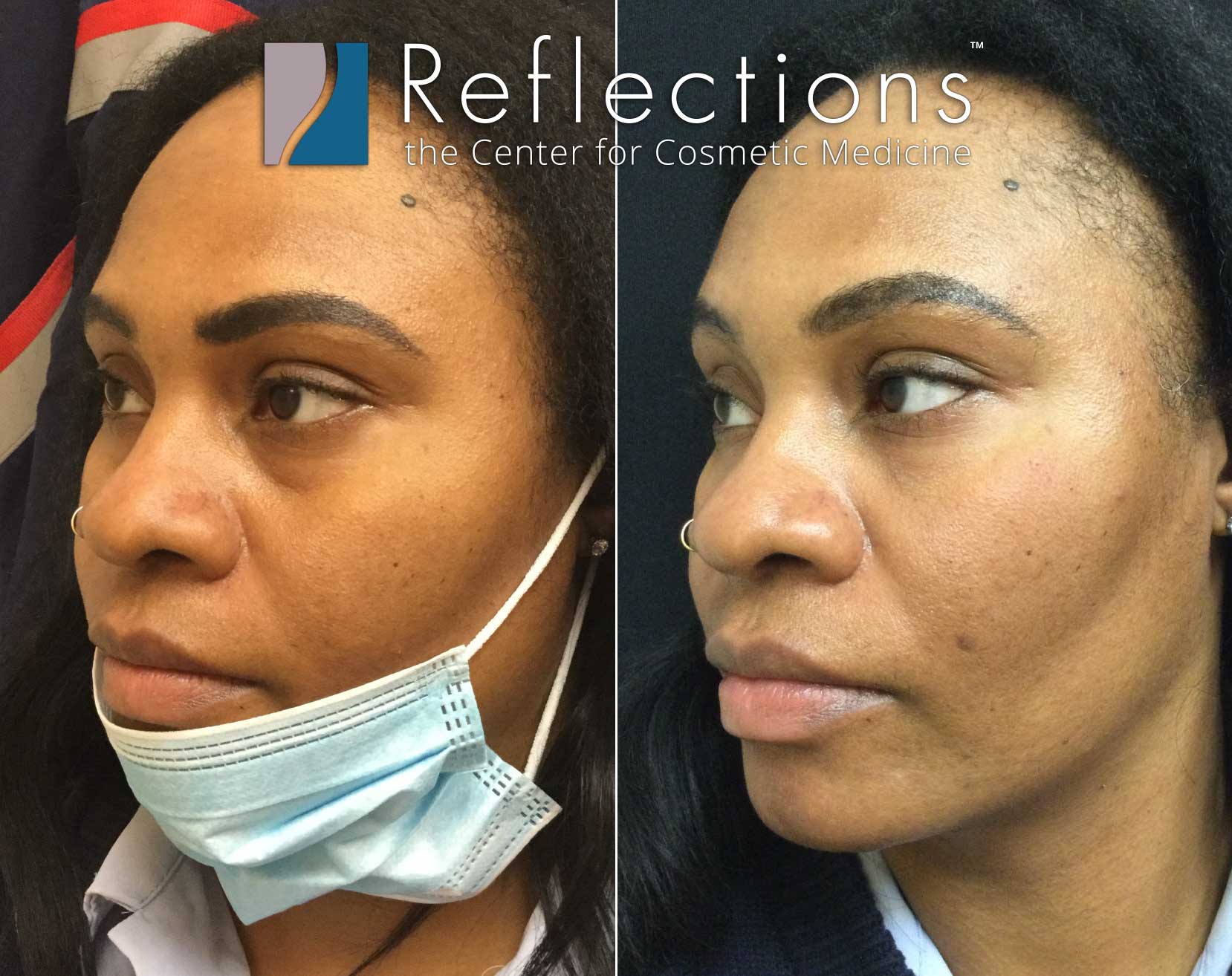 Under Eye Filler with Cheek Support Pre-Treatment with Filler Before &  After Photos New Jersey - Reflections Center
