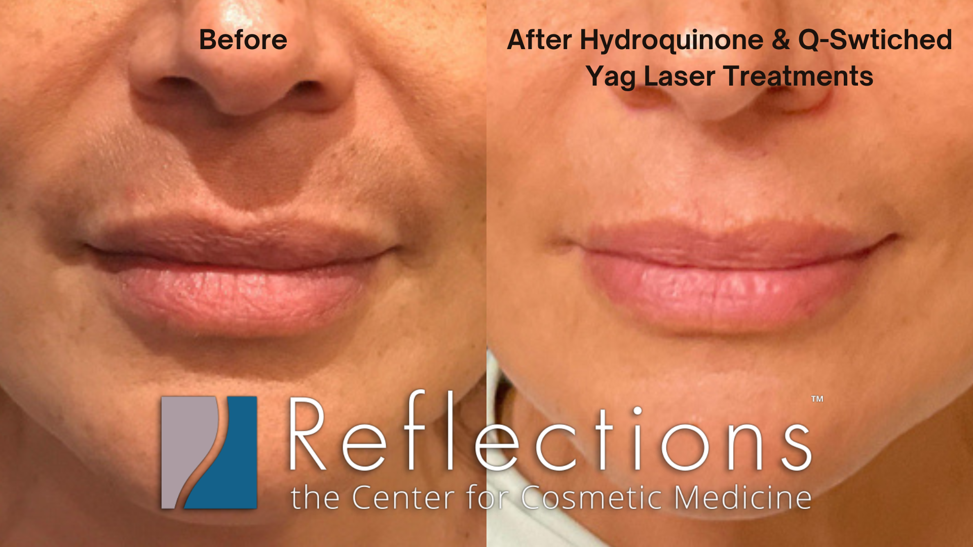 Q-Switched Laser Results for Dark Upper Lip (Caused by Melasma) Before &  After Photos New Jersey - Reflections Center