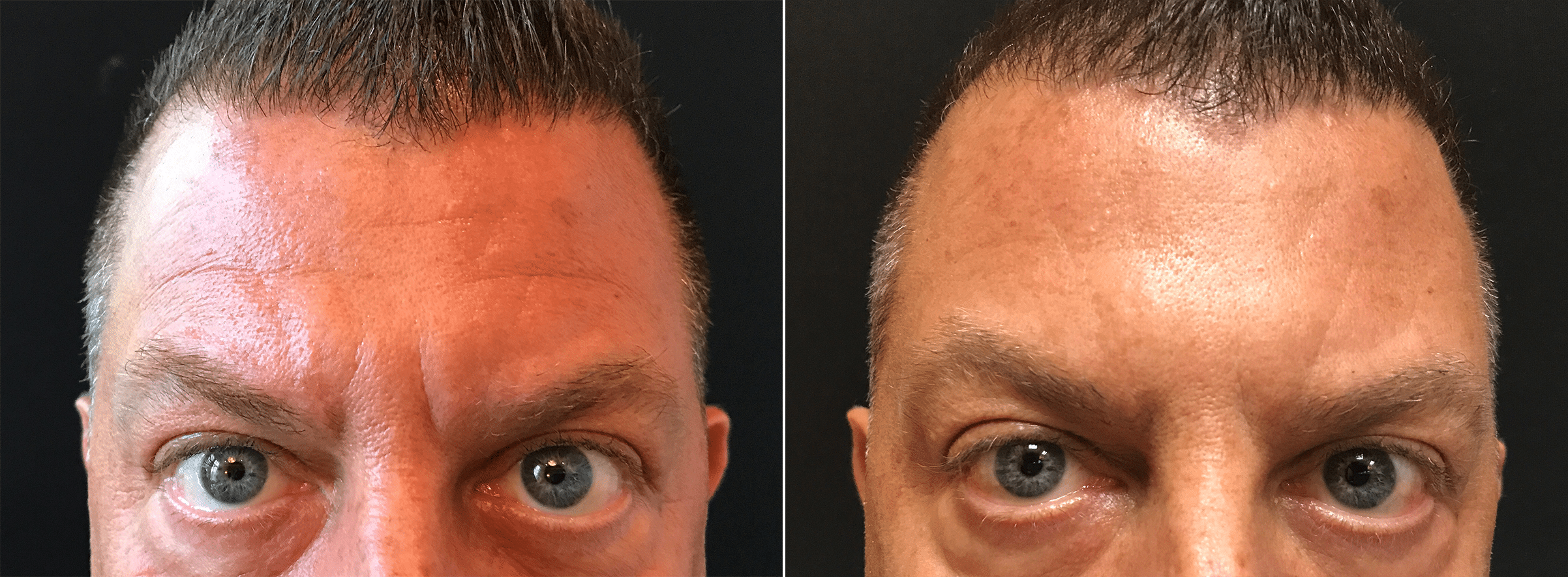 Male Botox for Forehead Lines and Frown Lines Before & After Photos New  Jersey - Reflections Center