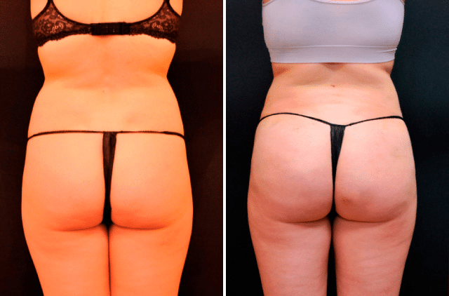Nordesthetics clinic - BBL (Brazilian buttock lift surgery) is a  combination of liposuction and fat transfer to buttocks. At first, the fat  is taken from a certain body area (abdomen, back, thighs