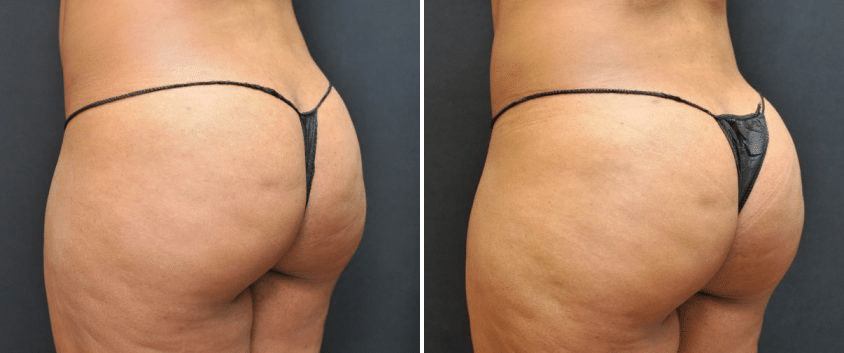 Large Volume BBL Fat Transfer and Body Contouring, NJ