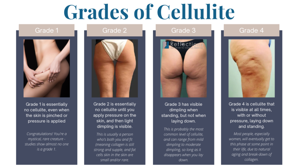 Grades of Cellulite