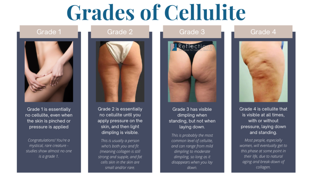 Best Cellulite Treatments Near Me NJ