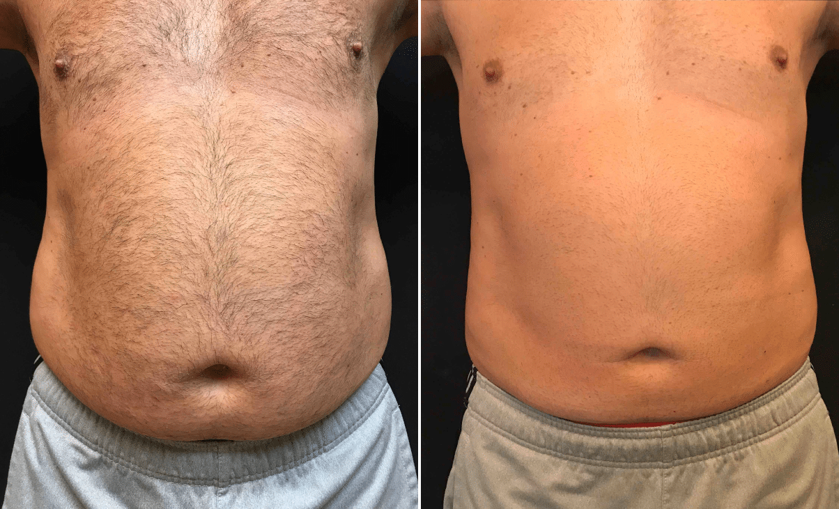 CoolSculpting Love Handles, Coolsculpting flanks before and after