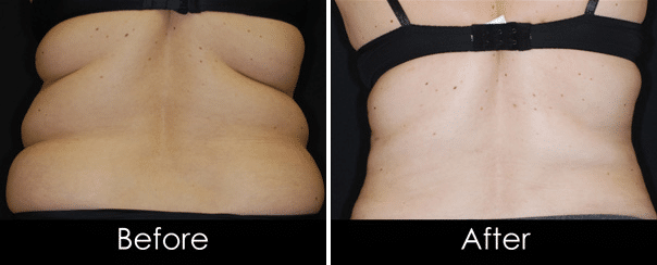 Bra Rolls / Back Fat Before & After Photos New Jersey