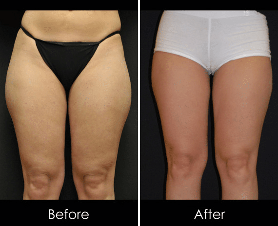 What to do about Inner Thigh Sagging